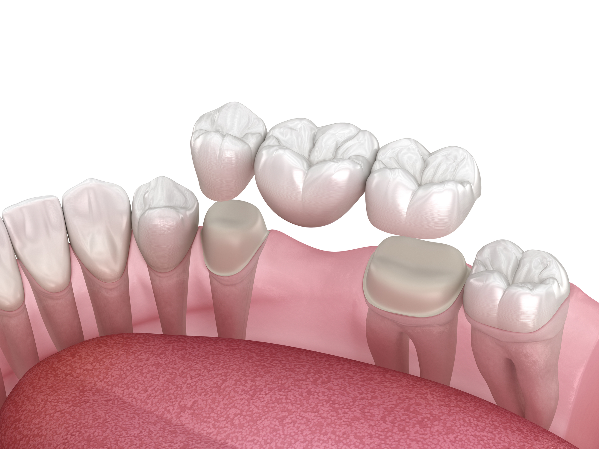 Eine Zahnbrücke: Was ist das und wie funktioniert sie?